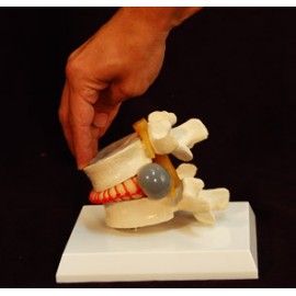Simulador vertebral con hernia discal. (VER-00001)