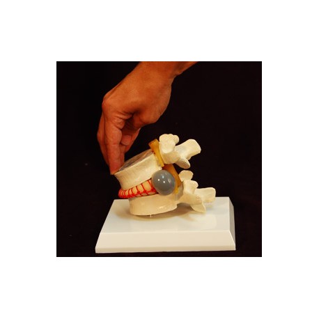 Simulador vertebral con hernia discal. (VER-00001)
