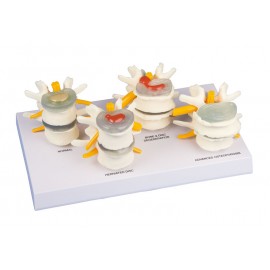 Tipos de discos vertebrales (ER-7576)