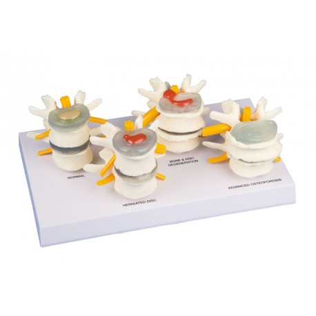 Tipos de discos vertebrales (ER-7576)